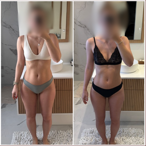Avant après Louise, perte de 7,1 kg en 3 mois